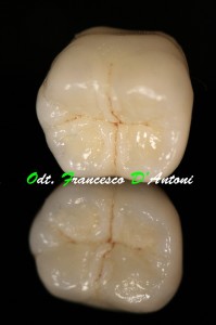 protesi-dentarie-metallo-cramica-odontotecnico-roma